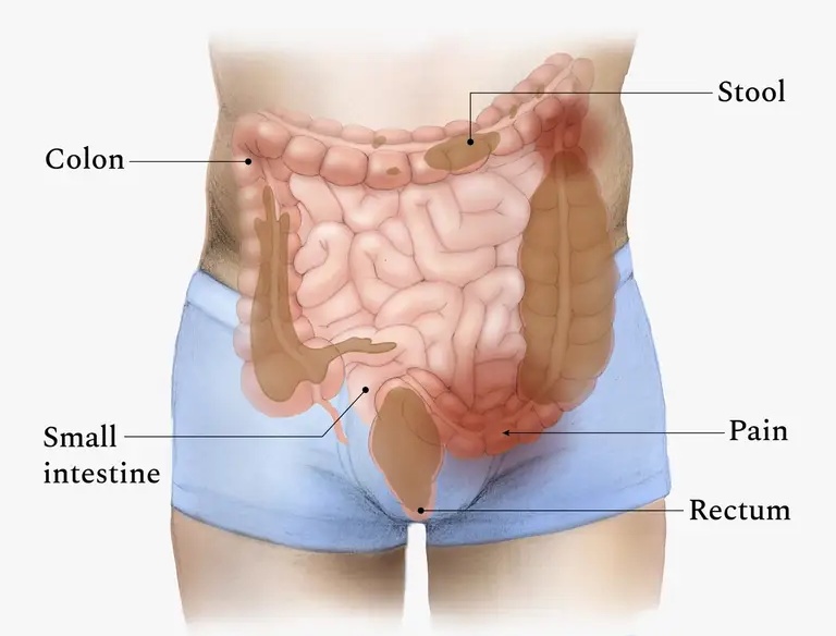 Doctor for Constipation Treatment in West Delhi
