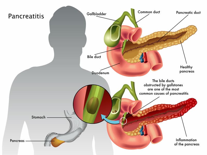 Chronic Pancreatitis in India
