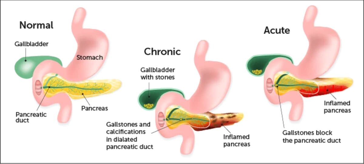 Pancreatic Inflammation in India